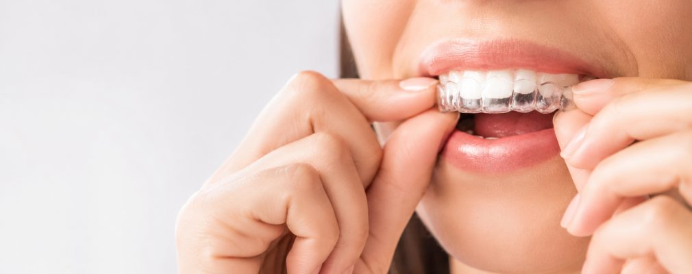 Aligner-Behandlung für gerade Zähne in Freiburg