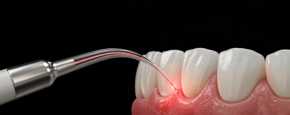 Moderne Laserzahnmedizin in Freiburg bei Zahnarztpraxis Sally Abdelhamid